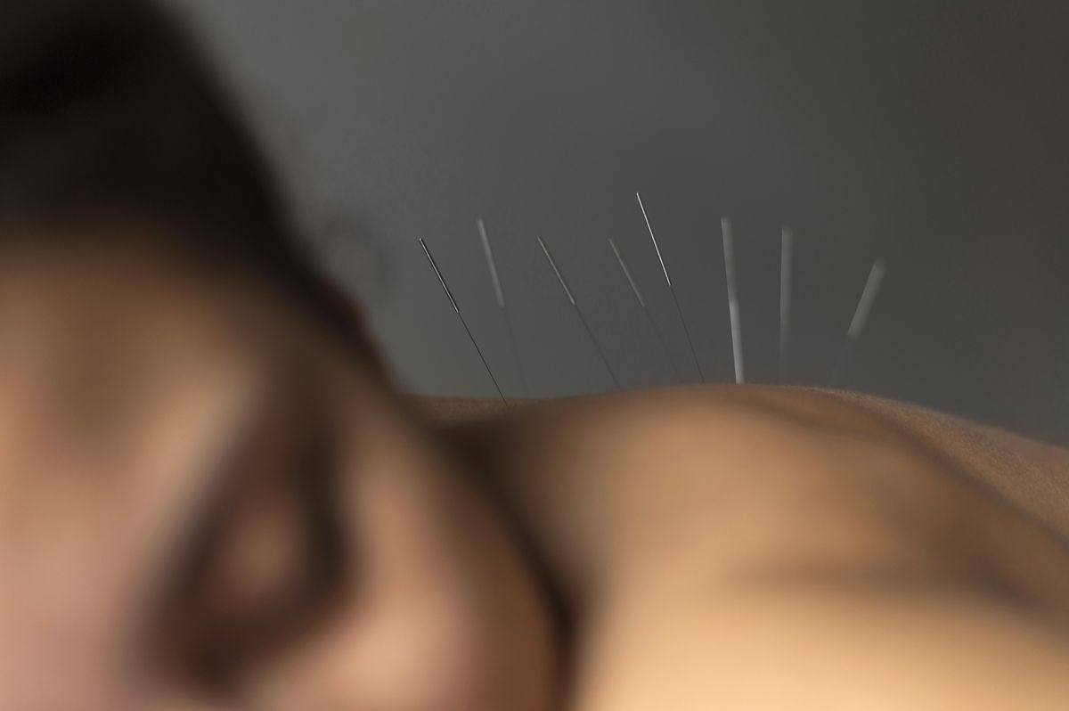Aiguilles d'acupuncture posées sur les points des méridiens