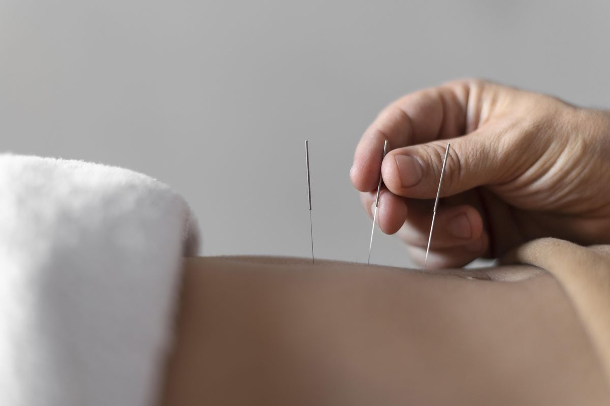 Aiguilles d'acupuncture sur les points des méridiens de la jambe